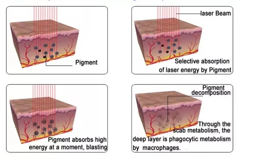 532nm, 1064nm, 1320nm Laser Portable Tattoo Removal Carbon Peeling Pigmentation Removal ND YAG